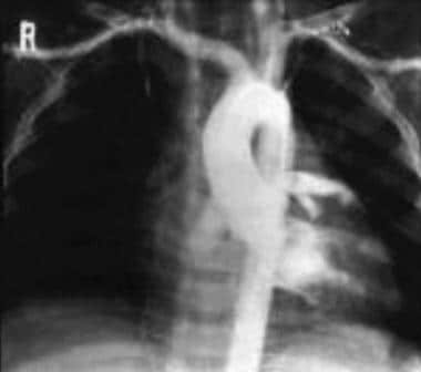 Kawasaki disease. Angiogram of the ascending aorta