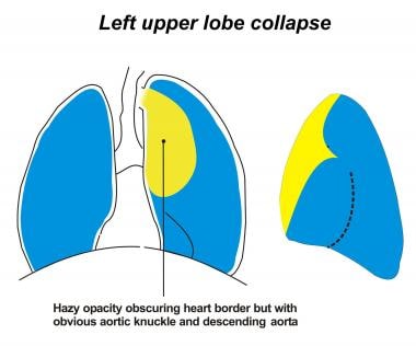 Image depicting a left upper lobe collapsing super