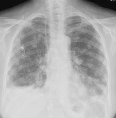 Chest radiograph in a 62-year-old woman with malig