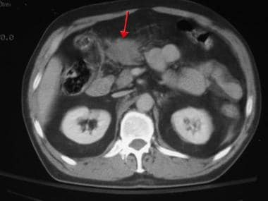 Patient with blunt abdominal trauma with duodenal 