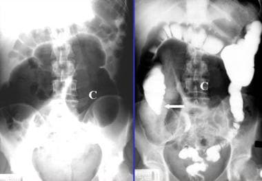Left: Plain abdominal radiograph from a 48-year-ol