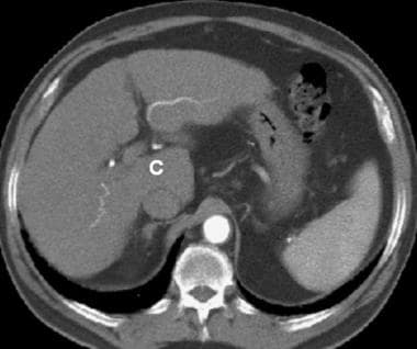 Patient with cirrhosis showing tortuous hepatic ar