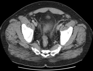 CT scan demonstrates typical sigmoid diverticuliti