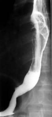 Lateral barium esophagram demonstrates a large, in