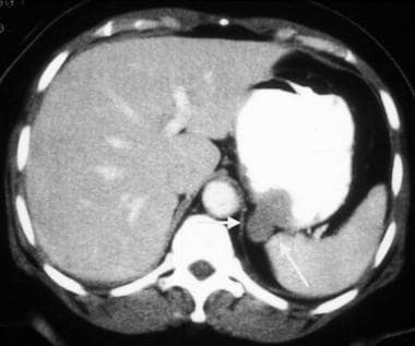 Gastrointestinal stromal tumor (GIST). CT scan obt