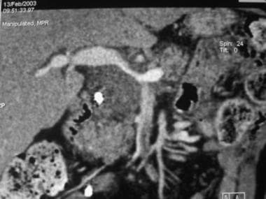 Coronal reconstruction shows a mass encasing and n