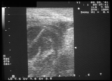 An intraoperative sonogram is used to guide needle