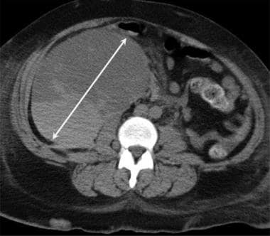 Axial CT of the pelvis demonstrates a large hemato