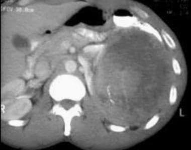 Case 1. Large renal cell carcinoma. Contrast-enhan