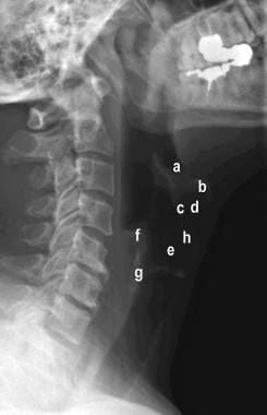 Lateral radiograph of the neck showing the differe