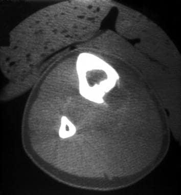 一个釉质瘤患者的CT扫描显示