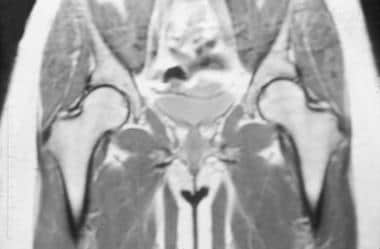 Coronal T1 MRI of the pelvis and hips in a patient
