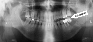 Panoramic radiographic image of the left angle fra