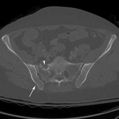 Open book pelvic injury, Radiology Reference Article