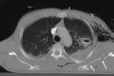 Axial computed tomography image in a patient with 