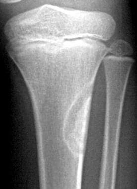 Frontal radiograph in a 9-year-old with trauma to 