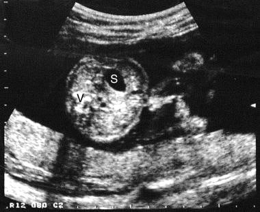 Axial sonogram through the mid to upper abdomen. T