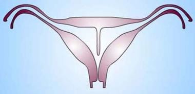 Uterus, müllerian duct abnormalities. Septate uter