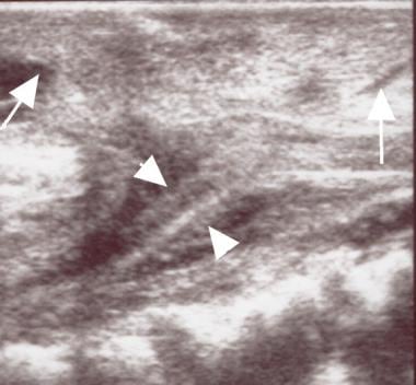 Sagittal ultrasonogram in a patient with a Chiari 
