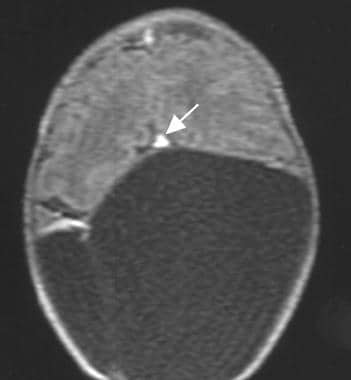 An axial T1-weighted MRI showing an elevated, ante