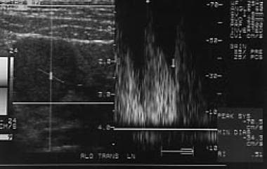 Spectral Doppler sonogram demonstrates nodal hyper