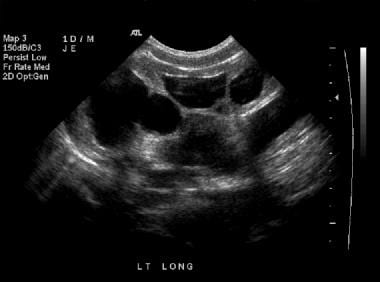 Renal sonogram (same patient as in the previous 3 