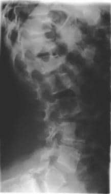 Image shows bullet-nose hypoplastic vertebrae with