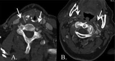 Axial CT angiograms (A and B) demonstrate bilatera