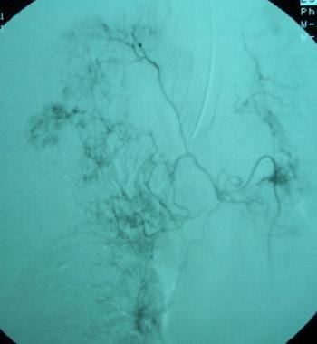 Bronchial artery embolization digital-subtraction 