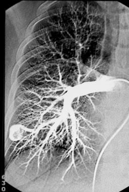 Pulmonary angiography. Right pulmonary angiogram s