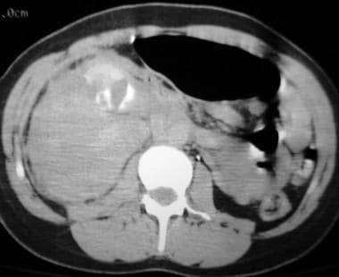 A 30-year-old woman who sustained blunt abdominal 
