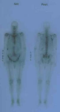 Anterior and posterior bone scans of a patient wit