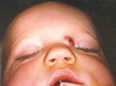 A patient with a congenital nasal dermoid. 