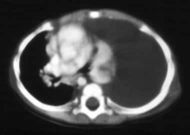 CT scan of chest shows a hemothorax on the left si