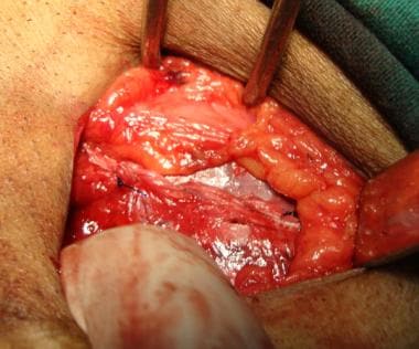 INGUINAL HERNIA REPAIR – CSF Surgery