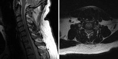 T2-weighted sagittal (left) and axial (right) MRI 