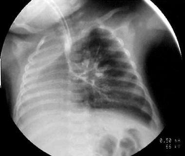 Bronchogram of the same patient (a 3-month-old inf