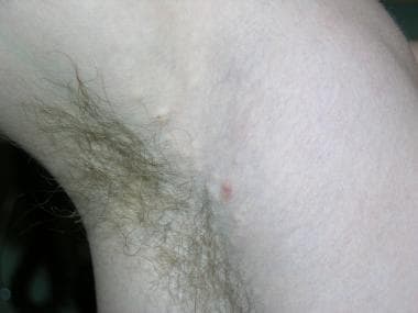 Eruptive vellus hair cysts in the axilla. 