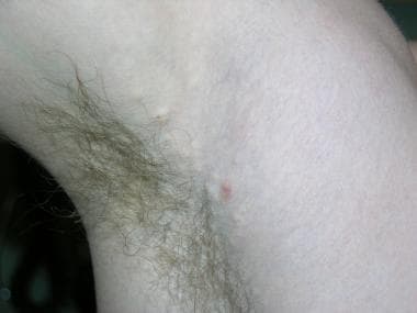 eruptive vellus hair cysts