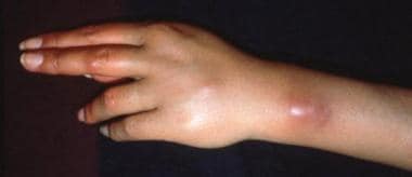 Mycobacterium marinum infection. Courtesy of the D