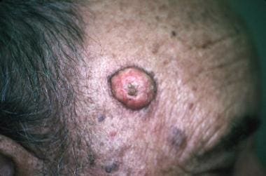 Keratoacanthoma lesion (squamous cell carcinoma-ke