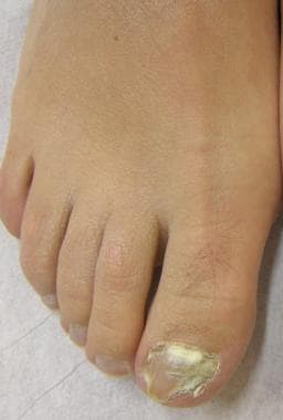 Proximal subungual onychomycosis. Proximal leukony