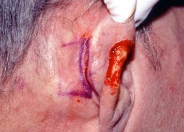Planned incision for a postauricular flap. 