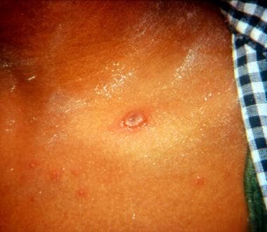 What Does The Characteristic Chickenpox Varicella Vesicle Look Like