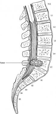 Illustration demonstrating an example of cauda equ