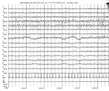 Focal status epilepticus. This electroencephalogra