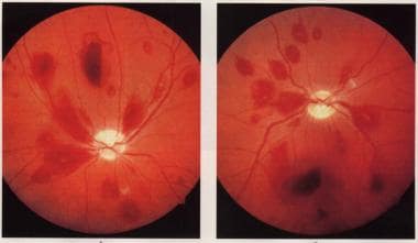 Ischemic retinopathy caused by severe megaloblasti