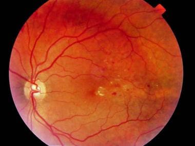 Fundus photograph of clinically significant macula