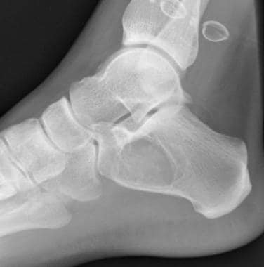 Lateral heel radiograph showing the spur length. (a) Oblique line... |  Download Scientific Diagram