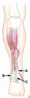 Posterior tibial tendon (C) is pulled through slit
